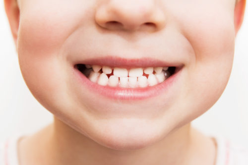 Child with Orofacial Myofunctional Disorder